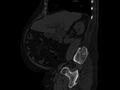 Ankylosing spondylitis (Radiopaedia 44609-48357 Sagittal bone window 34).jpg