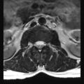 Ankylosing spondylitis with zygapophyseal arthritis (Radiopaedia 38433-40516 Axial T2 17).jpg