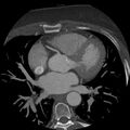 Anomalous origin of left circumflex artery from right coronary sinus (Radiopaedia 72563-83117 A 37).jpg
