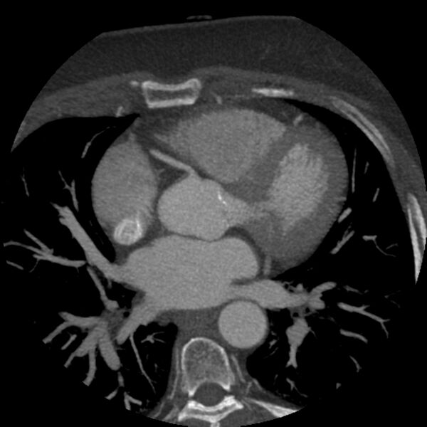 File:Anomalous origin of left circumflex artery from right coronary sinus (Radiopaedia 72563-83117 A 37).jpg