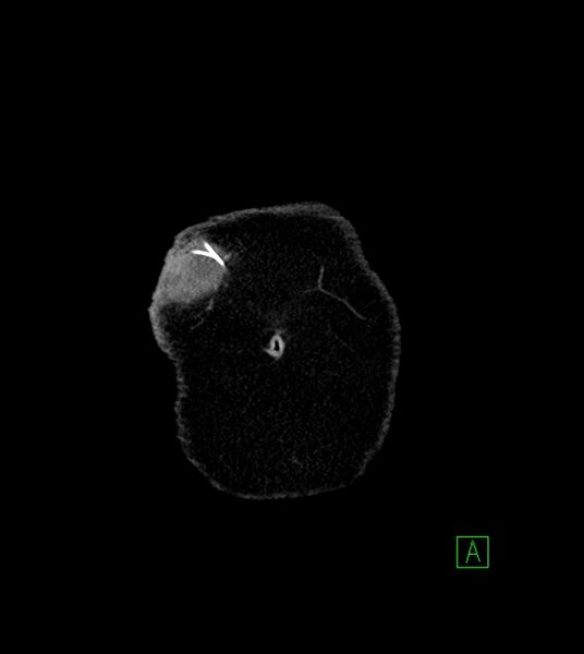 File:Anterior abdominal wall CSF pseudocyst (CSFoma) (Radiopaedia 79453-92571 B 4).jpg
