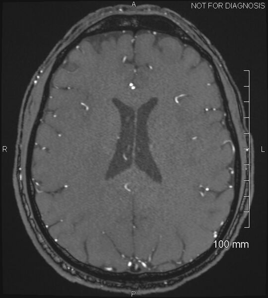 File:Anterior cerebral artery aneurysm (Radiopaedia 80683-94127 Axial MRA 156).jpg