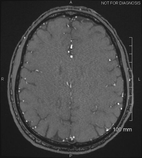 File:Anterior cerebral artery aneurysm (Radiopaedia 80683-94127 Axial MRA 171).jpg