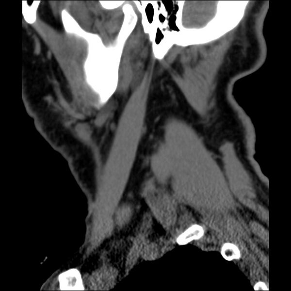 File:Anterior cervical postdiscectomy arthrodesis (Radiopaedia 32678-33646 C 46).jpg