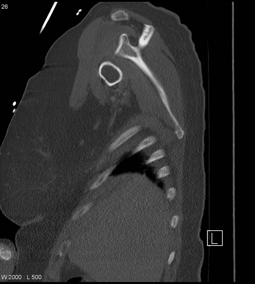Anterior shoulder dislocation (CT) (Radiopaedia 59032-66309 Sagittal bone window 13).jpg