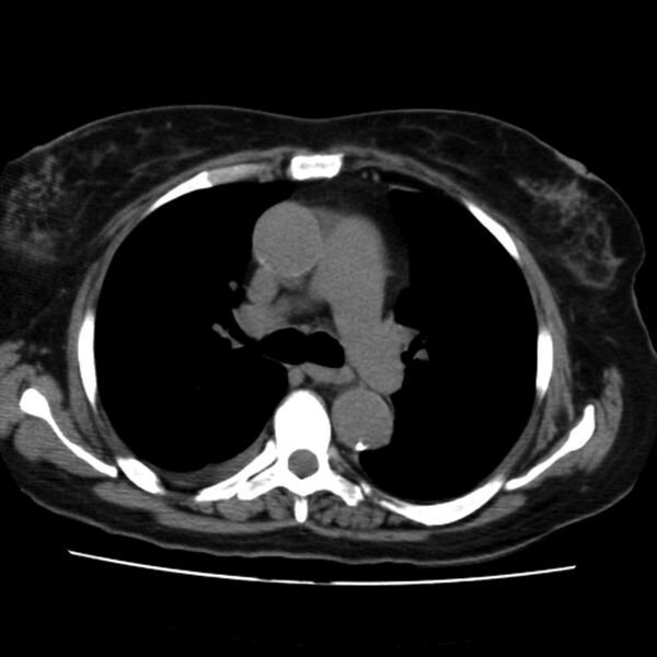 File:Aortic arch pseudoaneurysm (Radiopaedia 8534-9368 Axial non-contrast 30).jpg