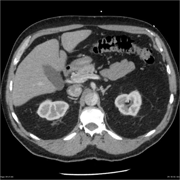 File:Aortic dissection- Stanford A (Radiopaedia 37759-39664 A 80).jpg