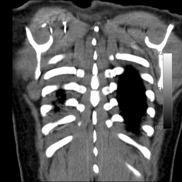 File:Aortic dissection - Stanford type A (Radiopaedia 29247-29659 B 54).jpg