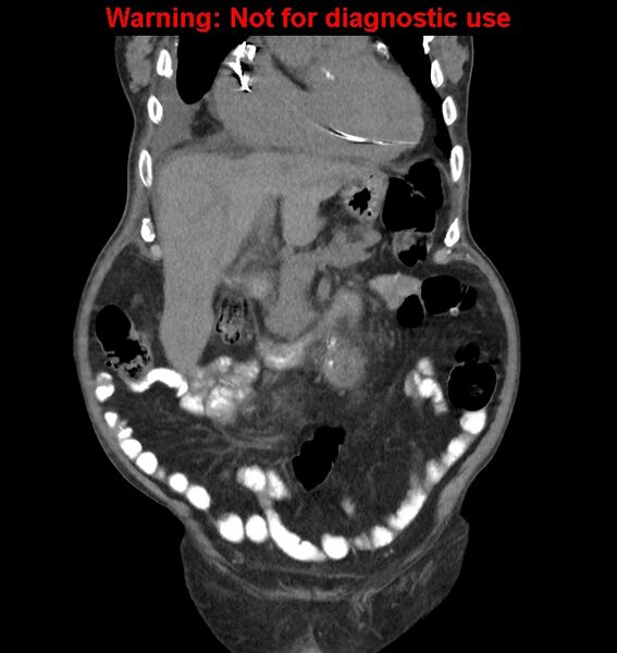 File:Aortic graft infection (Radiopaedia 44979-48907 non-contrast 16).jpg