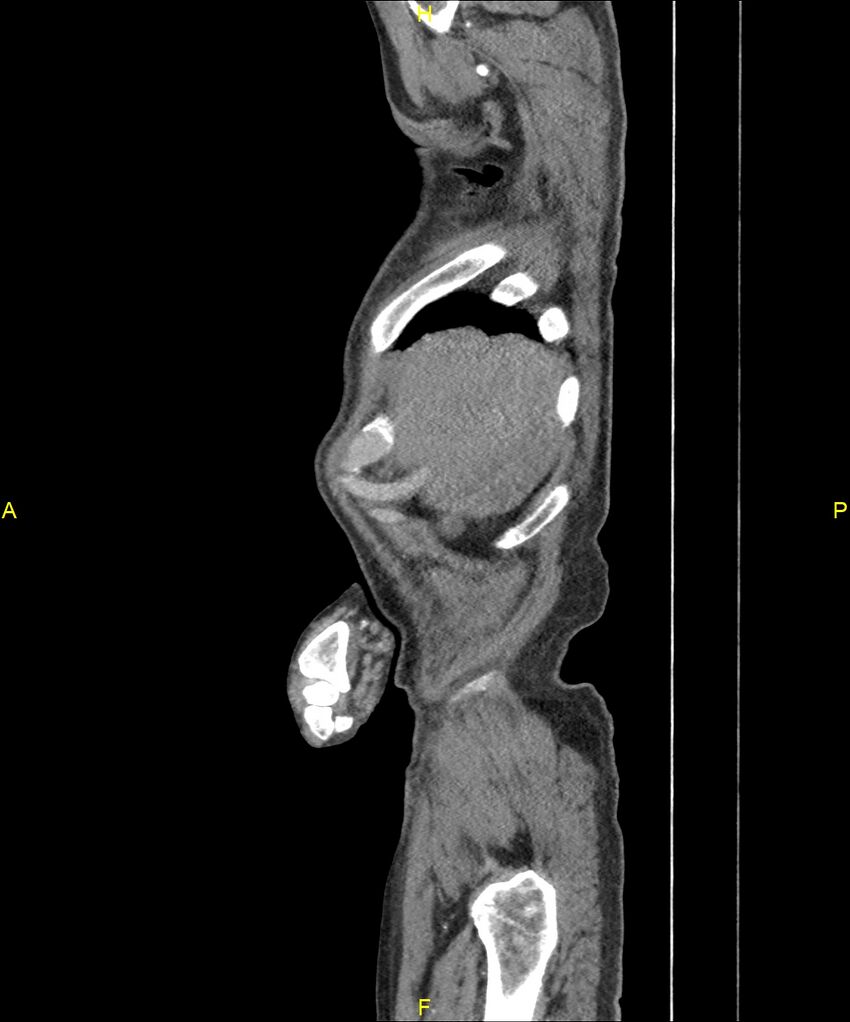 Aortoenteric fistula (Radiopaedia 84308-99603 C 29).jpg