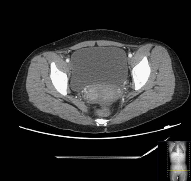 File:Appendicitis (CT angiogram) (Radiopaedia 154713-127660 Axial 46).jpg