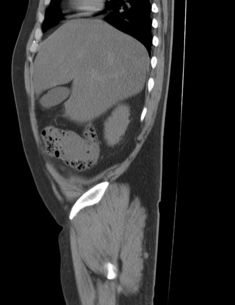 File:Appendicitis and giant appendicolith (Radiopaedia 80251-93588 C 4).jpg