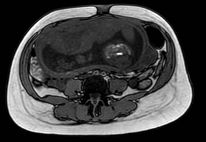 File:Appendicitis in gravida (MRI) (Radiopaedia 89433-106395 D 39).jpg