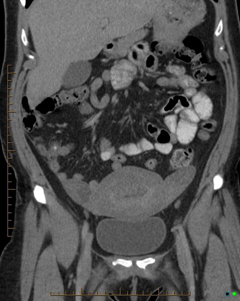 File:Appendicitis post recent cesarian section (Radiopaedia 29594-30102 D 1).jpg