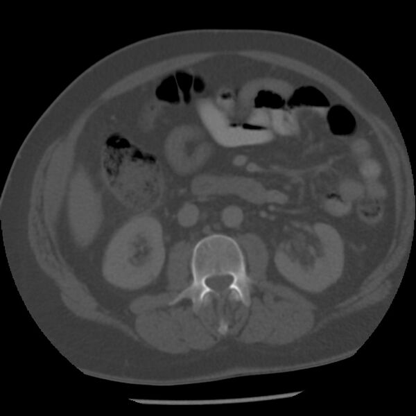 File:Appendicitis with perforation (Radiopaedia 35790-37342 Axial bone window 23).jpg