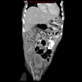 Appendicitis with phlegmon (Radiopaedia 9358-10046 B 18).jpg