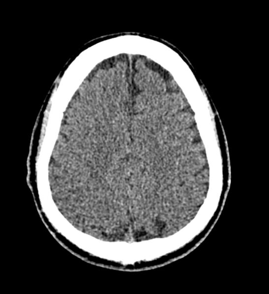 File:Arachnoid cyst of the ambient cistern (Radiopaedia 81301-94986 Axial non-contrast 53).jpg