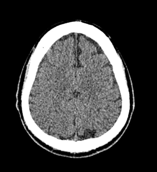 File:Arachnoid cyst of the ambient cistern (Radiopaedia 81301-94986 Axial non-contrast 54).jpg
