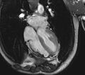 Arrhythmogenic right ventricular cardiomyopathy (Radiopaedia 39806-42237 D 49).jpg
