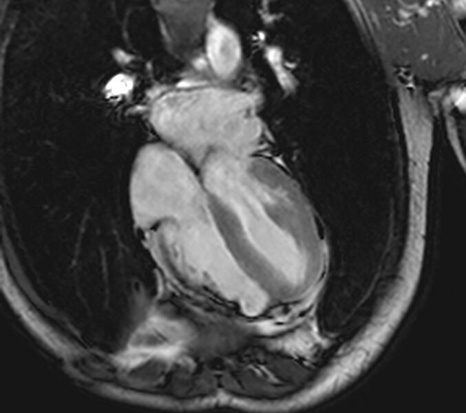 File:Arrhythmogenic right ventricular cardiomyopathy (Radiopaedia 39806-42237 D 49).jpg