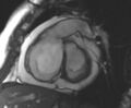 Arrhythmogenic right ventricular cardiomyopathy (Radiopaedia 69431-79307 Short axis cine 196).jpg
