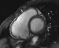 Arrhythmogenic right ventricular cardiomyopathy (Radiopaedia 69564-79464 short axis cine 183).jpg