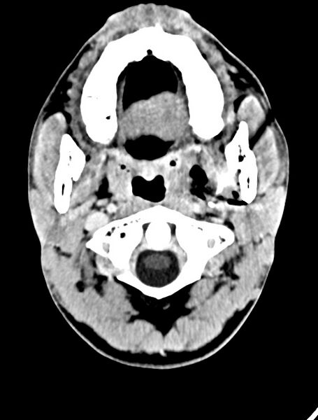File:Arrow injury to the face (Radiopaedia 73267-84011 Axial C+ delayed 27).jpg