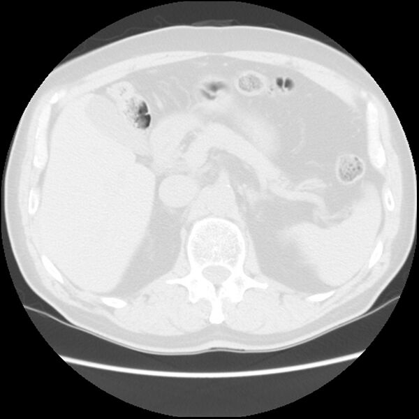 File:Asbestos-related pleural plaques (Radiopaedia 39069-41255 Axial lung window 74).jpg
