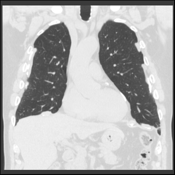 File:Asbestos-related pleural plaques (Radiopaedia 39069-41255 Coronal lung window 58).jpg