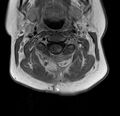 Astrocytoma - spinal cord (Radiopaedia 69769-79758 Axial T1 C+ 7).jpg