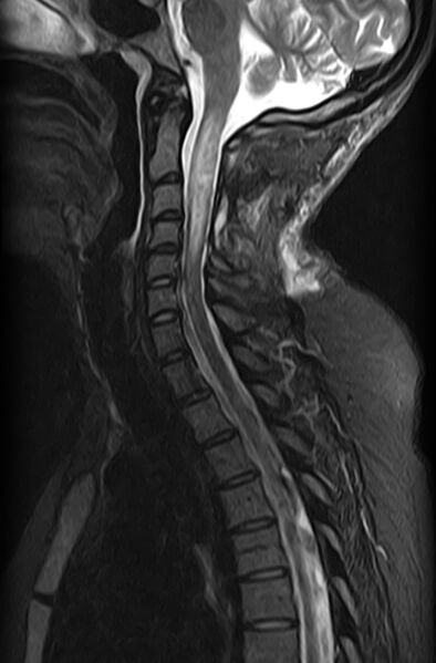 File:Astrocytoma - spinal cord (Radiopaedia 69769-79758 Sagittal STIR 6).jpg