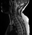 Astrocytoma - spinal cord (Radiopaedia 69769-79758 Sagittal T2 8).jpg