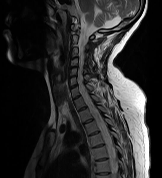 File:Astrocytoma - spinal cord (Radiopaedia 69769-79758 Sagittal T2 8).jpg