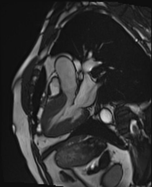 File:Asymmetric septal hypertrophic cardiomyopathy - systolic anterior motion of mitral leaflet (Radiopaedia 72795-83445 B 21).jpg