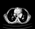 Atrial septal defect complicated by Eisenmenger syndrome (Radiopaedia 53707-59768 Axial C+ CTPA 10).jpg