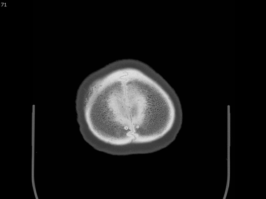 Atypical meningioma - intraosseous (Radiopaedia 64915-73867 Axial C+ bone window 71).jpg