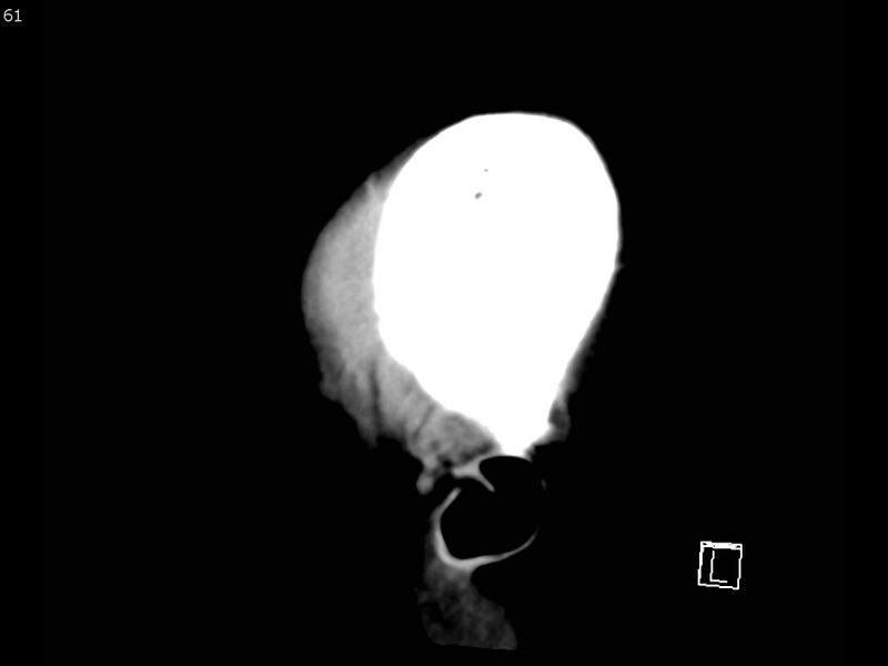 File:Atypical meningioma - intraosseous (Radiopaedia 64915-73867 C 59).jpg