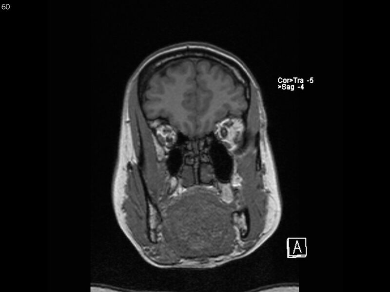 File:Atypical meningioma - intraosseous (Radiopaedia 64915-74572 Coronal T1 60).jpg