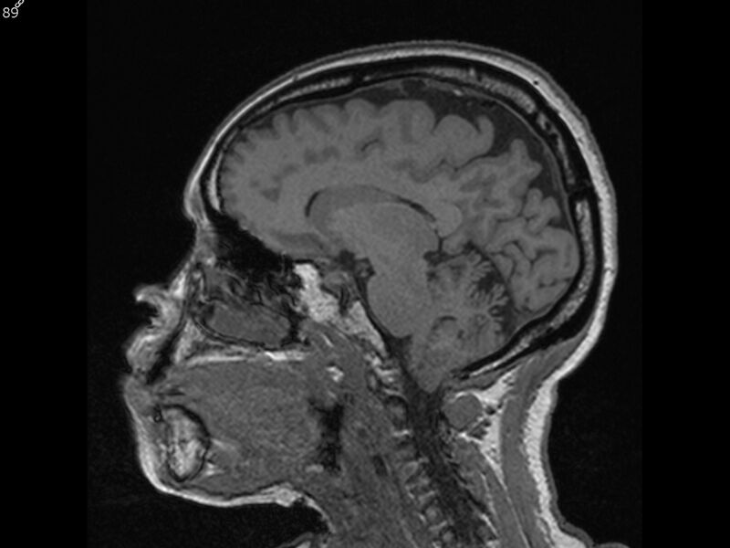 File:Atypical meningioma - intraosseous (Radiopaedia 64915-74572 Sagittal T1 89).jpg