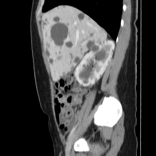 File:Autosomal dominant polycystic kidney disease (Radiopaedia 23061-23093 F 16).jpg