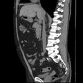 Autosomal dominant polycystic kidney disease (Radiopaedia 36539-38101 D 39).jpg