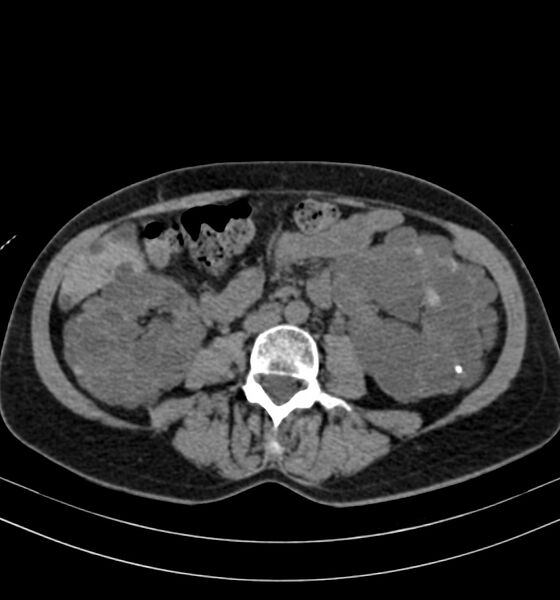 File:Autosomal dominant polycystic kidney disease (Radiopaedia 41918-44922 Axial non-contrast 18).jpg