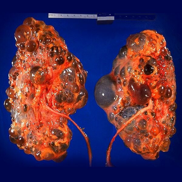 File:Autosomal dominant polycystic kidney disease (gross pathology) (Radiopaedia 9719).jpg