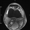 Avulsion fracture of the fibular head (Radiopaedia 74804-85808 Axial PD fat sat 8).jpg