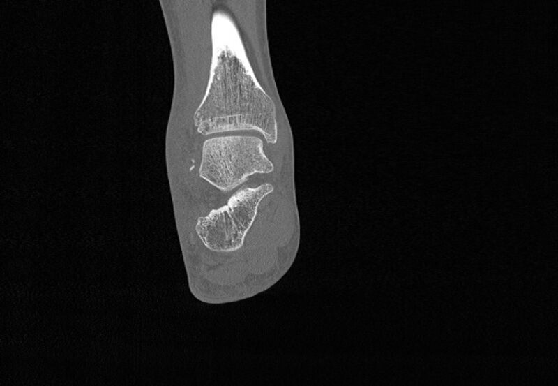 File:Avulsion fractures of talus and calcaneus (Radiopaedia 48277-53155 Coronal bone window 63).jpg