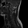 Axis fracture - MRI (Radiopaedia 71925-82375 Sagittal T2 2).jpg
