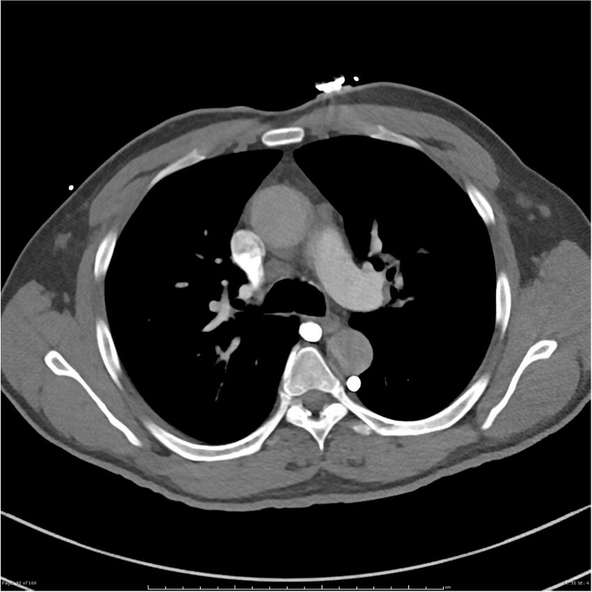 Azygos venous system anatomy (CT pulmonary angiography) (Radiopaedia 25928-26077 Axial C+ CTPA 32).jpg