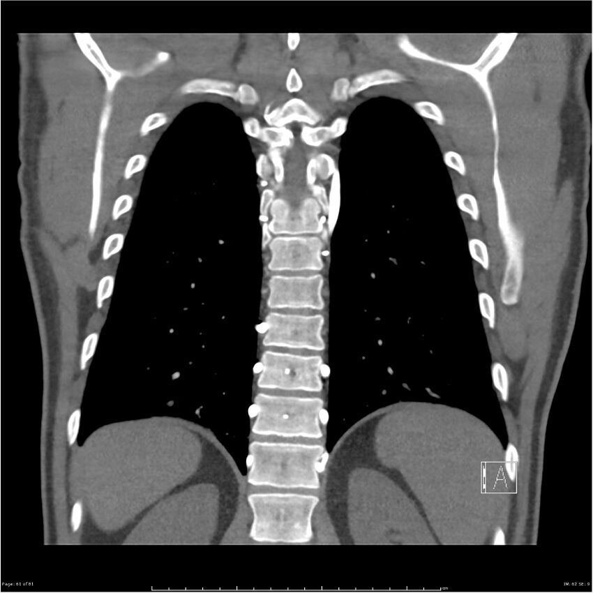 Azygos venous system anatomy (CT pulmonary angiography) (Radiopaedia 25928-26077 Coronal C+ CTPA 61).jpg