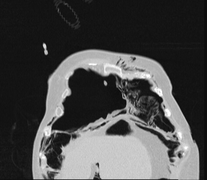 File:Barotrauma due to mechanical ventilation (Radiopaedia 28079-28336 Coronal lung window 16).jpg