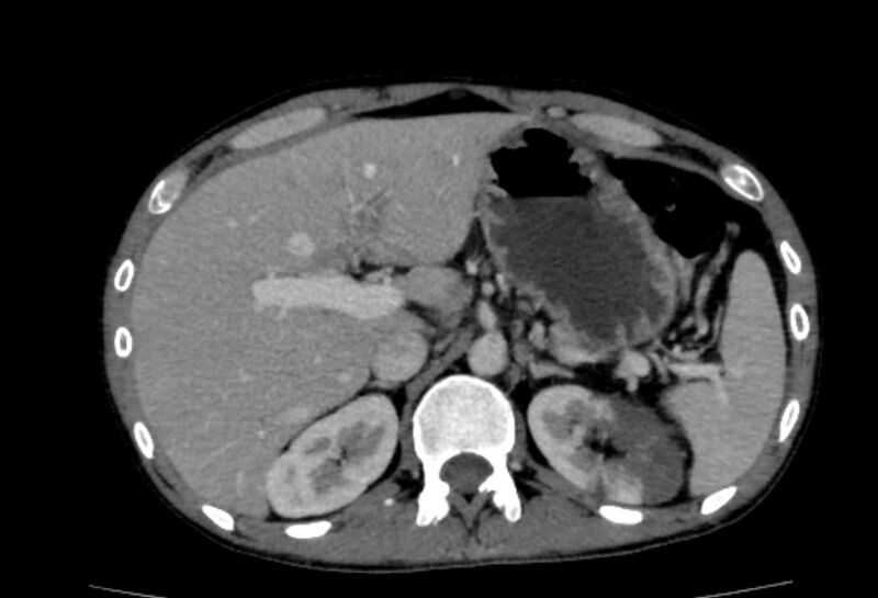File:Behçet's disease- abdominal vasculitis (Radiopaedia 55955-62570 A 17).jpg